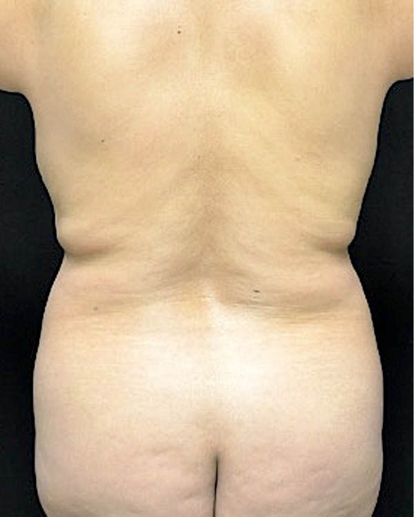 Liposuction case #5212