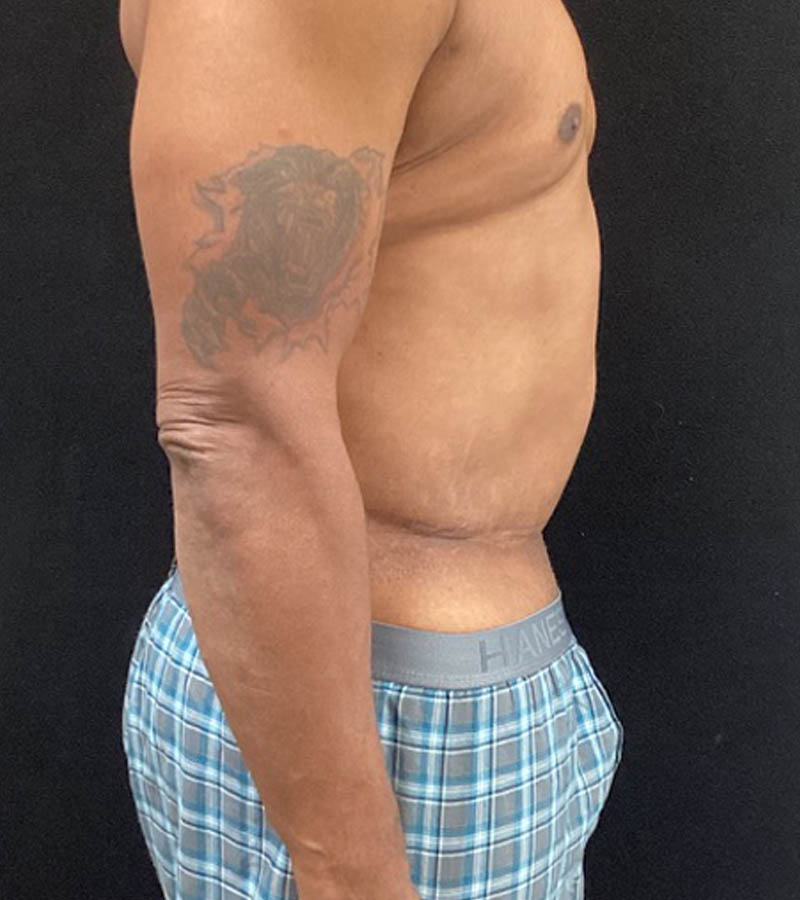 Gynecomastia case #5101