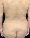 Liposuction case #5212
