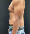 Gynecomastia case #5101