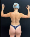 Liposuction case #5218