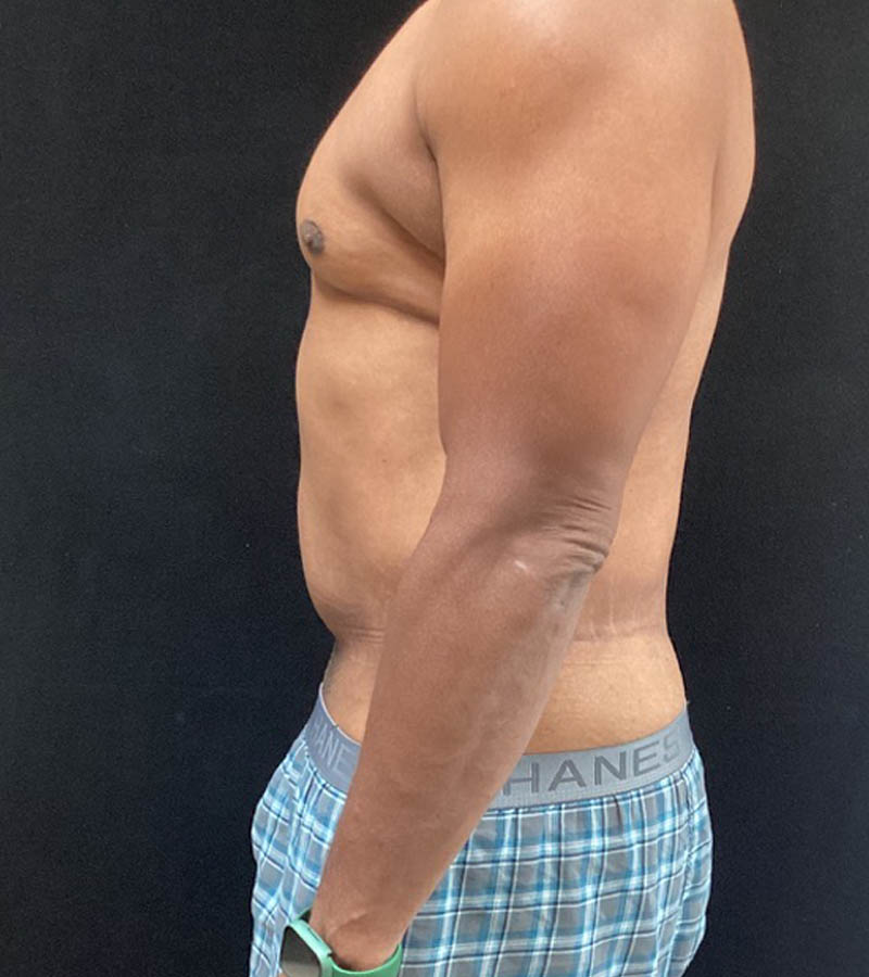 Gynecomastia case #5101