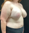 Breast Augmentation case #5040