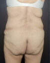 Liposuction case #5200