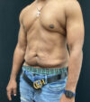 Gynecomastia case #5101