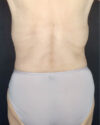 Liposuction case #5200