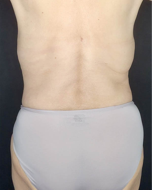 Liposuction case #5200