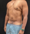 Gynecomastia case #5101