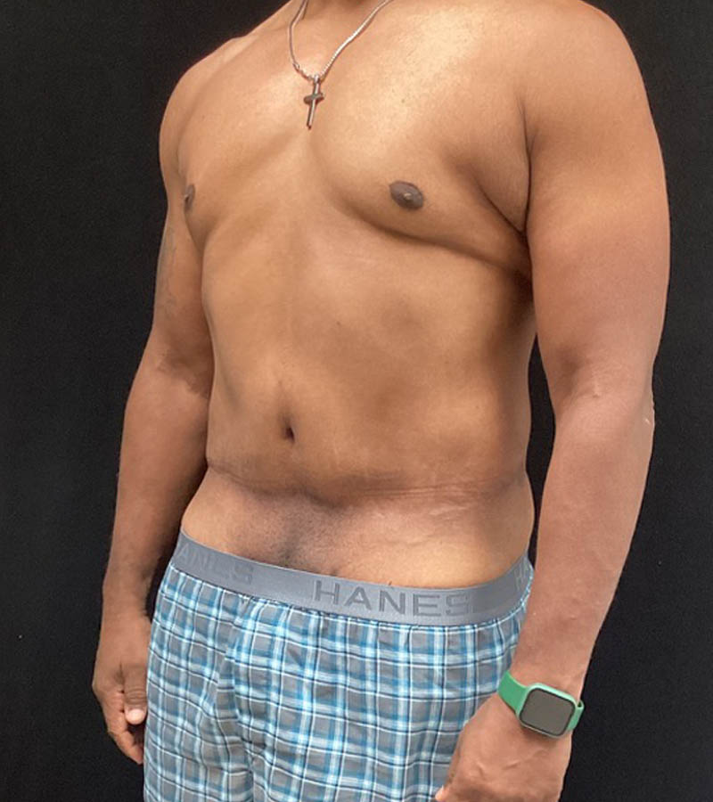 Gynecomastia case #5101