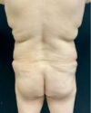 Liposuction case #5206