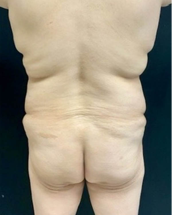 Liposuction case #5206