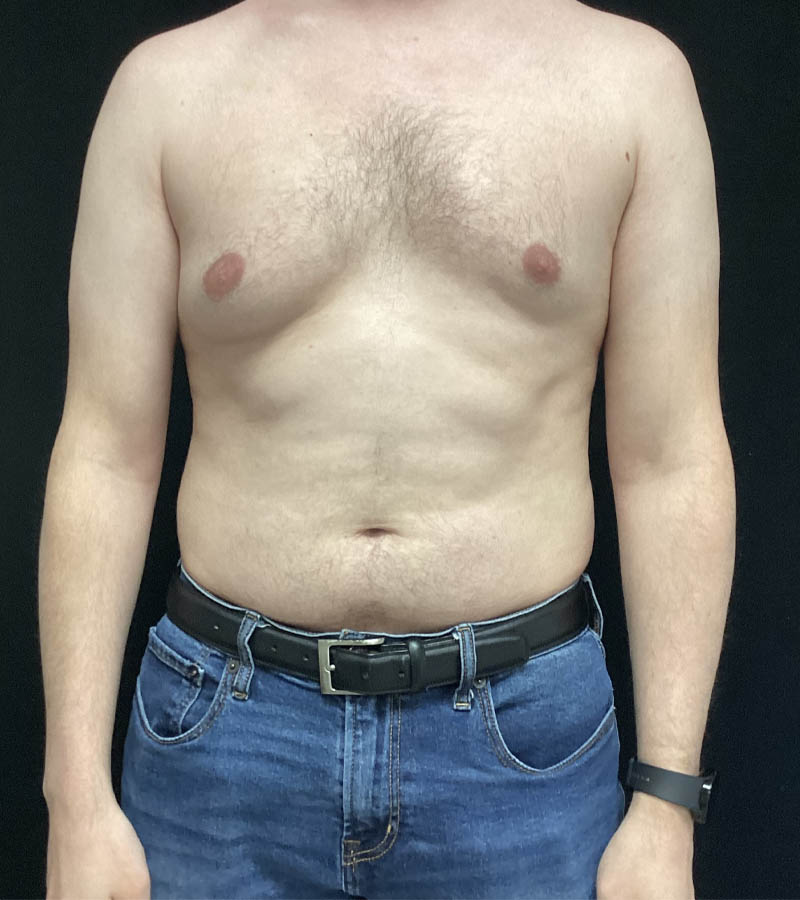 Gynecomastia case #5117