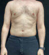 Gynecomastia case #5117