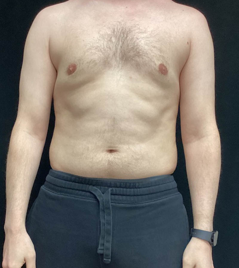 Gynecomastia case #5117