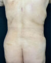 Liposuction case #5206