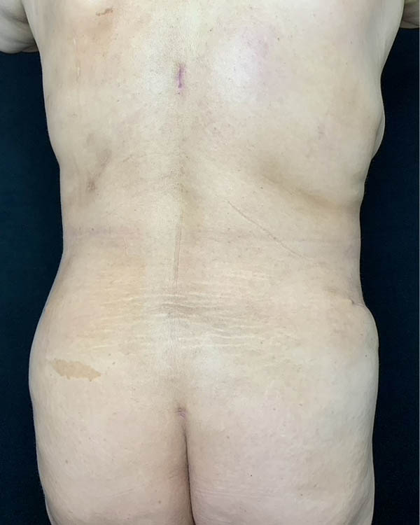 Liposuction case #5206