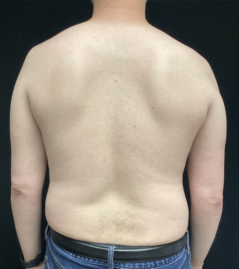 Gynecomastia case #5117