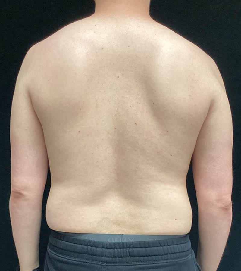 Gynecomastia case #5117