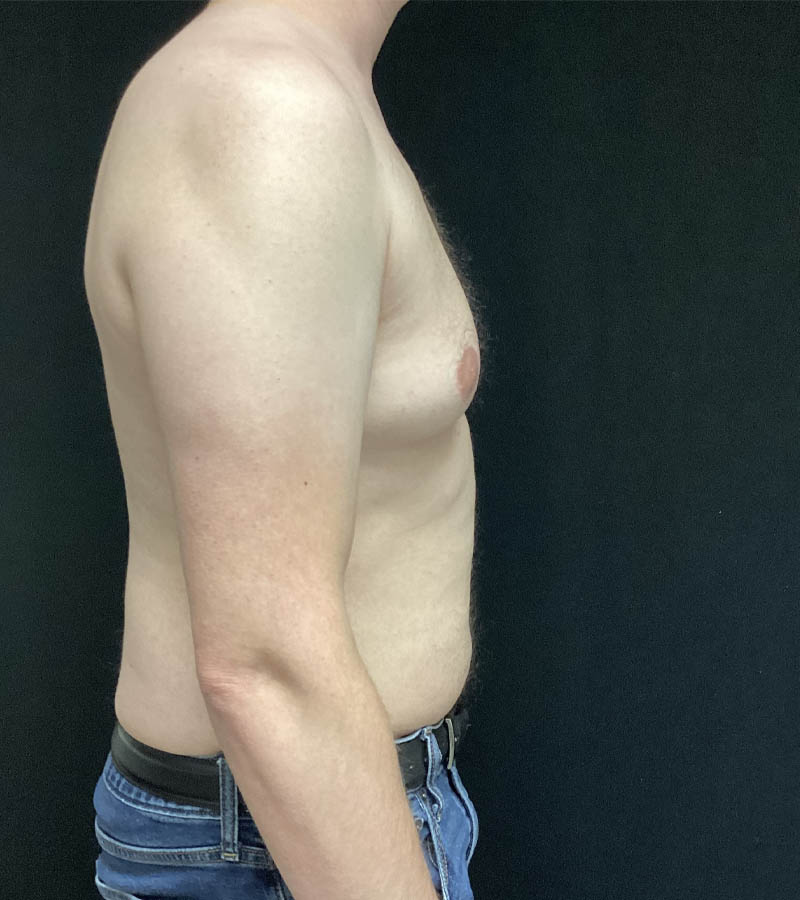 Gynecomastia case #5117