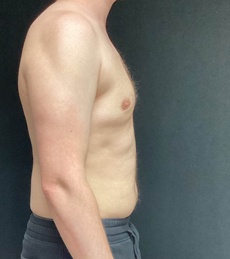 Gynecomastia case #5117
