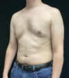 Gynecomastia case #5117