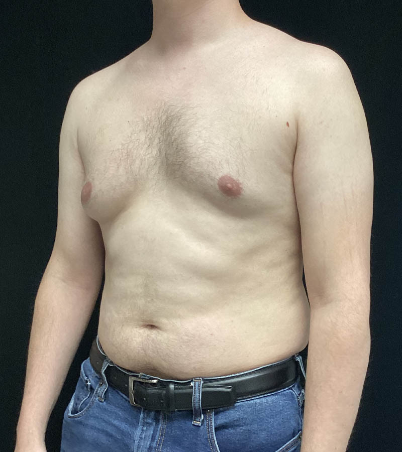 Gynecomastia case #5117