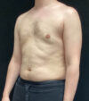 Gynecomastia case #5117