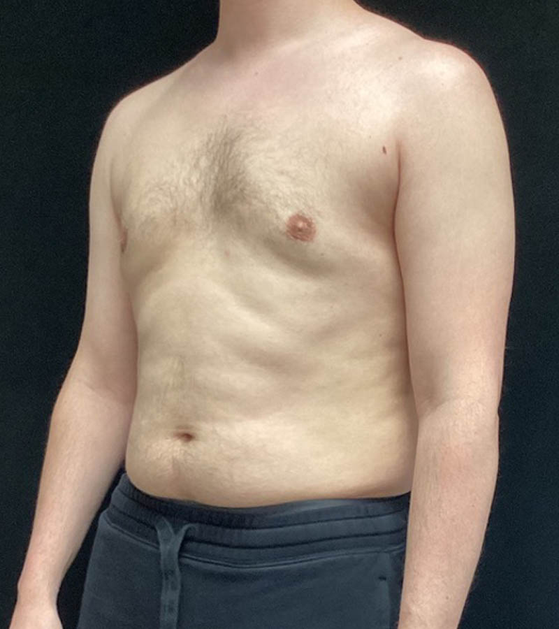 Gynecomastia case #5117
