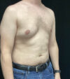 Gynecomastia case #5117