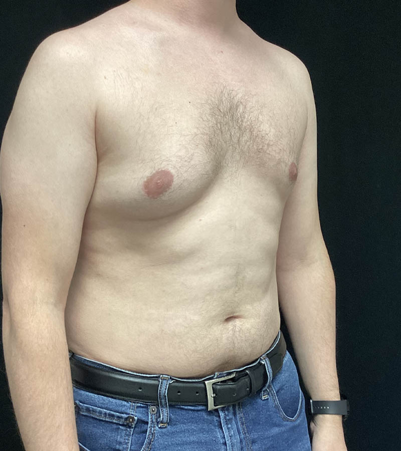 Gynecomastia case #5117