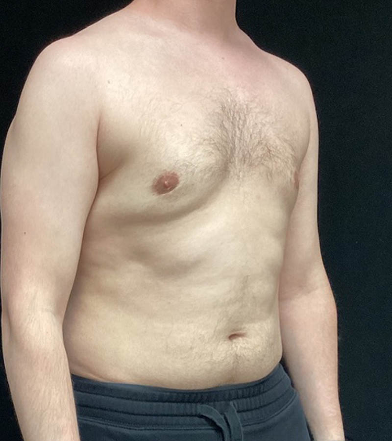 Gynecomastia case #5117