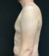 Gynecomastia case #5117