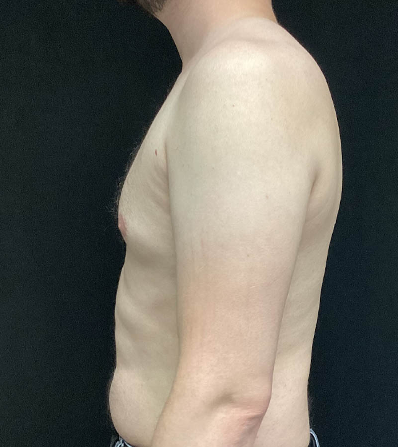 Gynecomastia case #5117