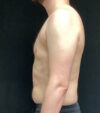Gynecomastia case #5117
