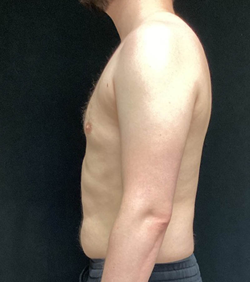 Gynecomastia case #5117