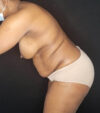 Mommy Makeover case #5133