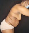 Mommy Makeover case #5133