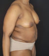 Mommy Makeover case #5133