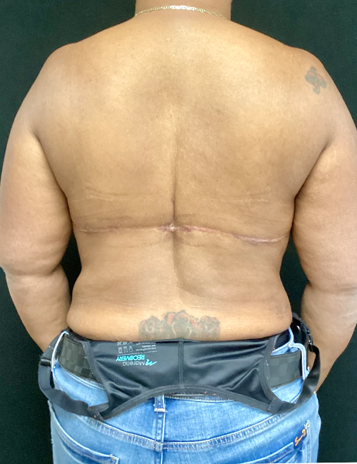 Body Lift case #5056