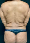 Plastic Surgery Revision case #5065