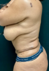 Plastic Surgery Revision case #5065