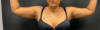 Liposuction case #5157