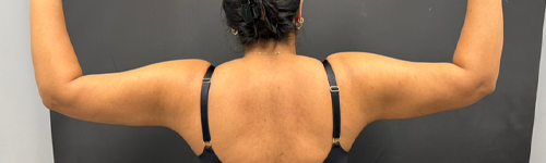 Liposuction case #5157