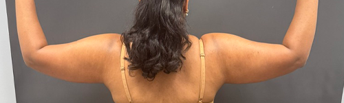 Liposuction case #5157