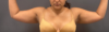 Liposuction case #5157