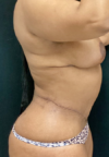 Plastic Surgery Revision case #5065