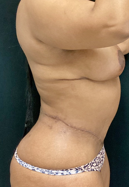 Plastic Surgery Revision case #5065