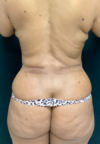 Plastic Surgery Revision case #5065