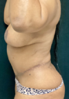 Plastic Surgery Revision case #5065